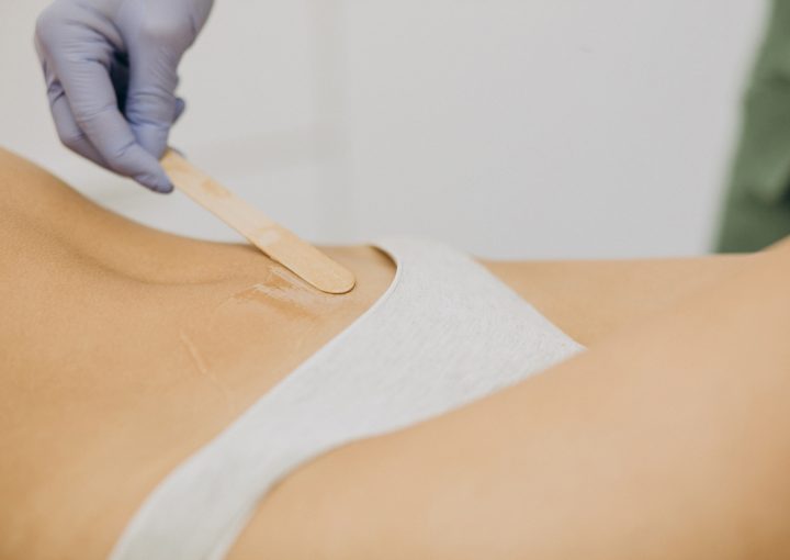 Лазер vs. Коламаска - Плюсове и минуси при премахване на нежелано окосмяване